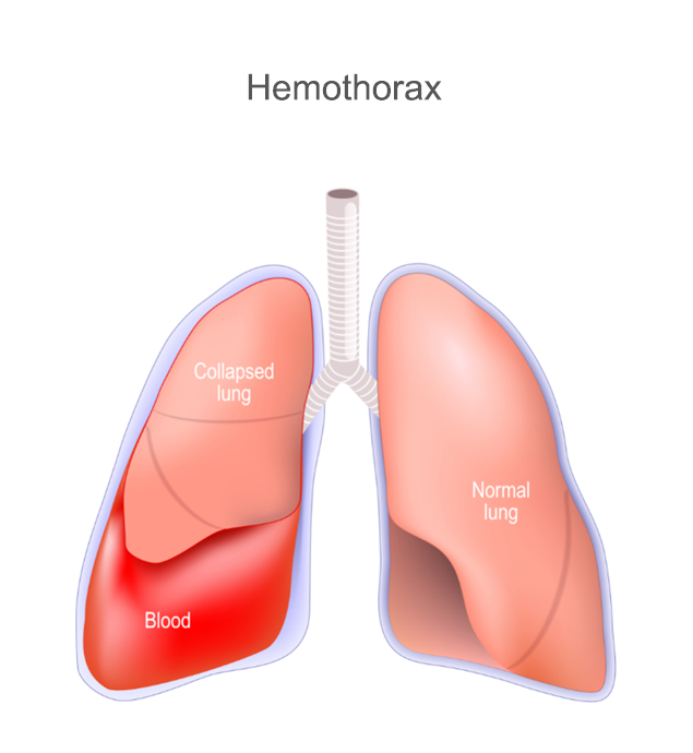 Collapsed lung - hemothorax
