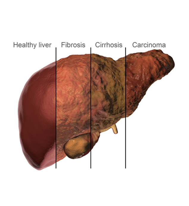 4 conditions of liver: healthy, Fibrosis, Cirrhosis, Carcinoma 
