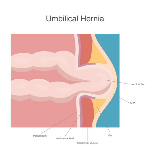 Umbilical hernia